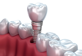 Zero Peri-implantitis Concept インプラント周囲炎 Zero Peri-Implantitis: A Novel Concept in Implant Dentistry